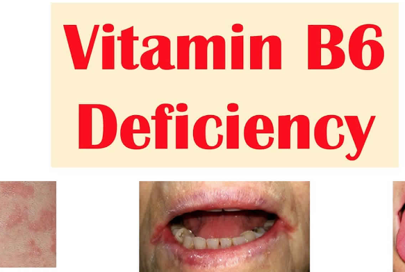 Causes of B6 and Progesterone Deficiency.png Causes of B6 and Progesterone Deficiency.png